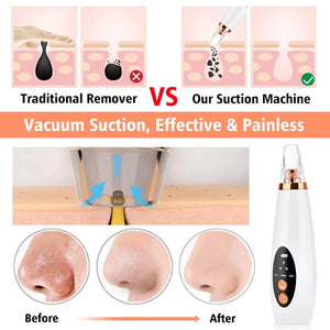 ELECTRIC BLACKHEAD VACUUM CLEANER - BODYHEALTHTODAY
